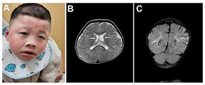 A Novel Mutation in ATRX Causes Alpha-Thalassemia X-Linked Intellectual Disability Syndrome in a Han Chinese Family